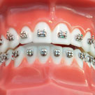 Brace tooth brackets